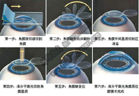 准分子激光手术五大误区