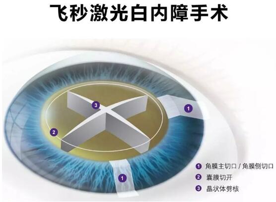 飞秒激光白内障手术